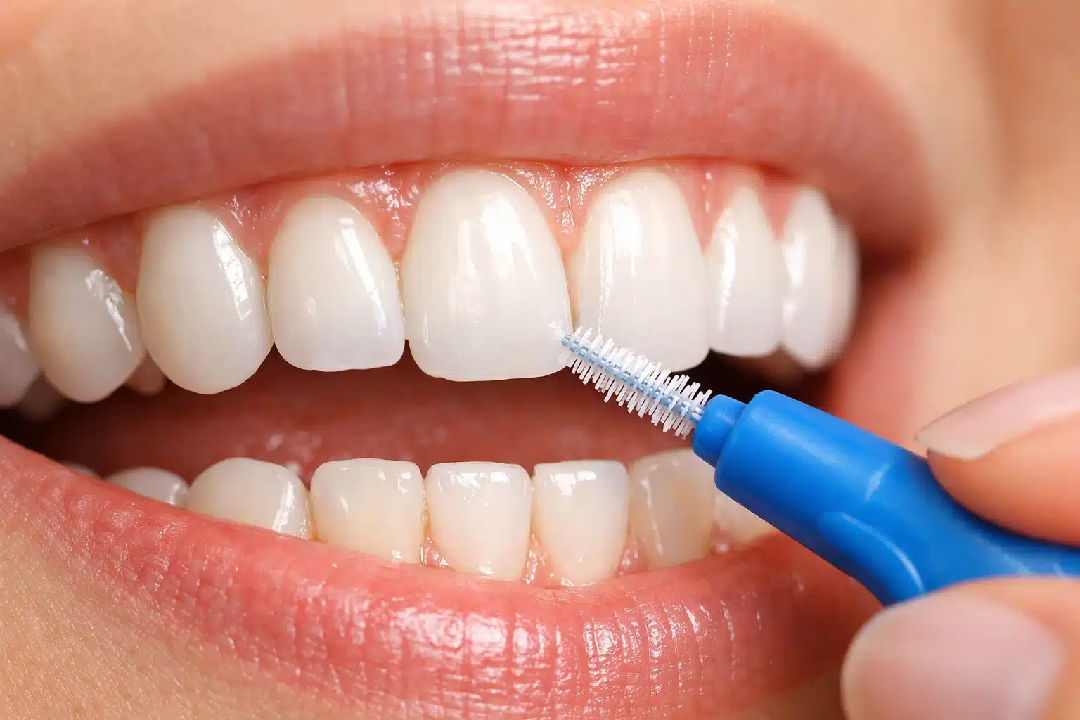 Interdental Brushes vs Dental Floss