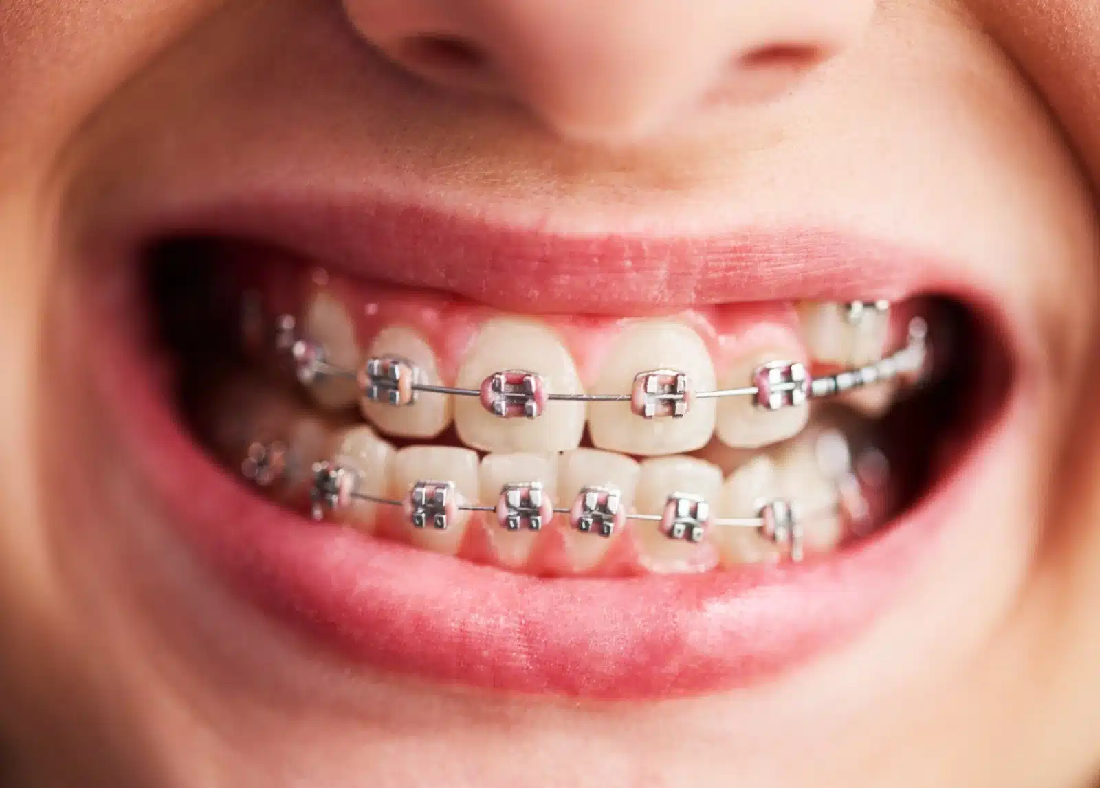 braces