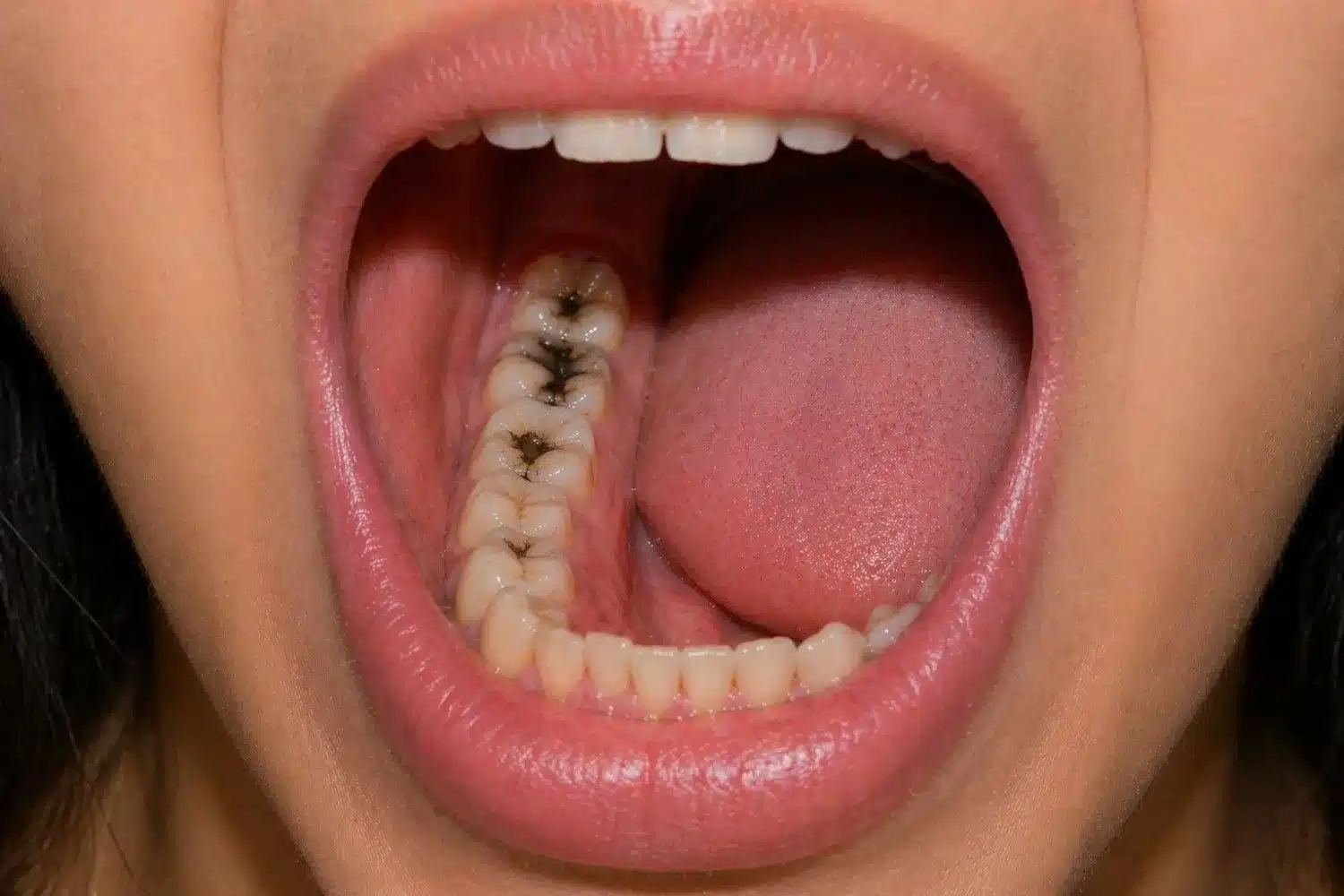 Cavity from Teeth