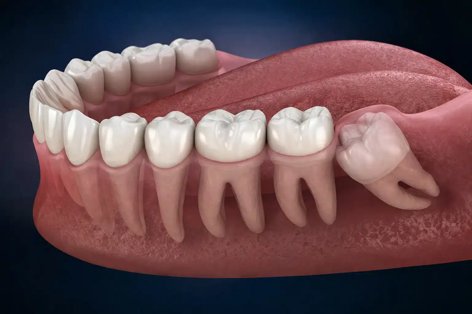 Wisdom Tooth Removal