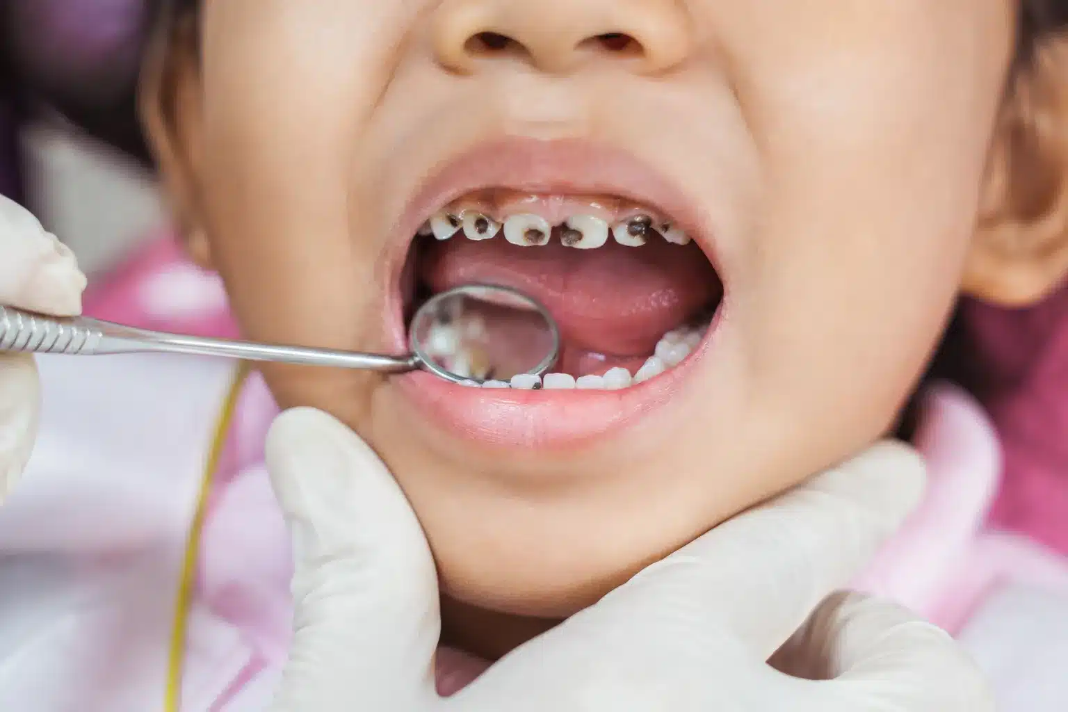 How to Prevent Tooth Decay in Children